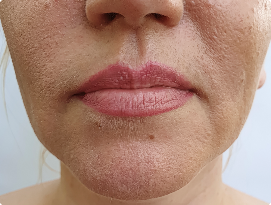 Dry and dehydrated skin