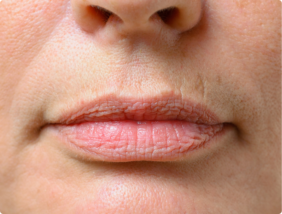 Nasolabial Folds
