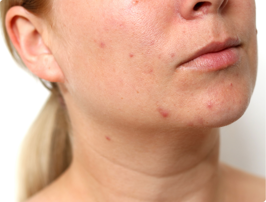 Acne and post-breakout marks