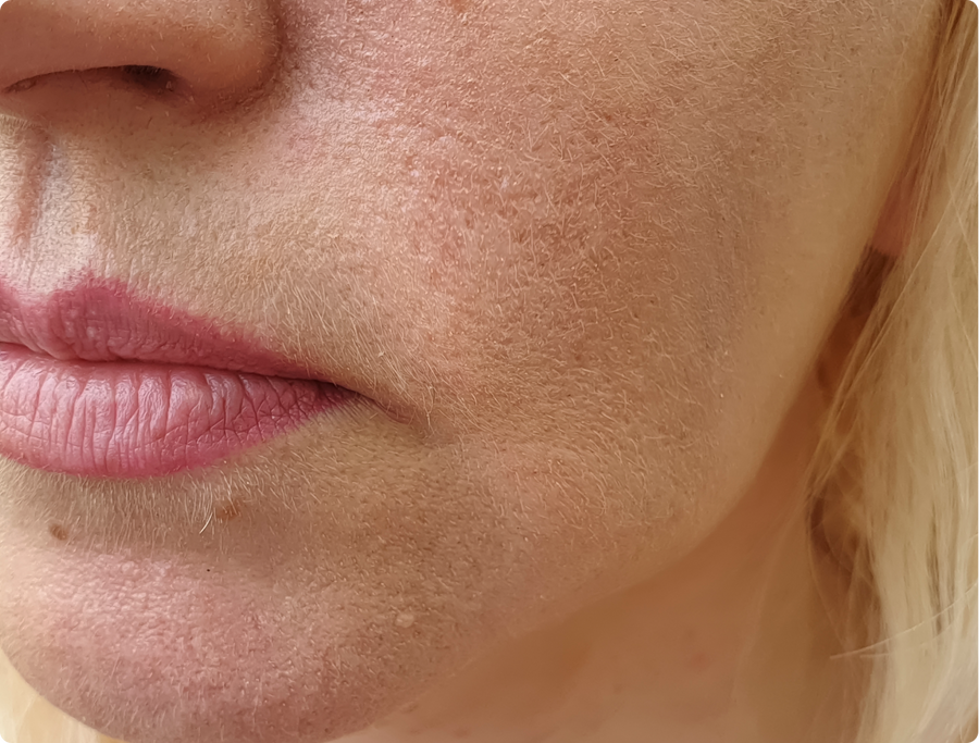 Dry and dehydrated skin