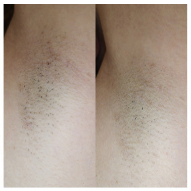 Ulike Air 2 IPL Hair Removal for Underarm, Bikini & Legs Hair