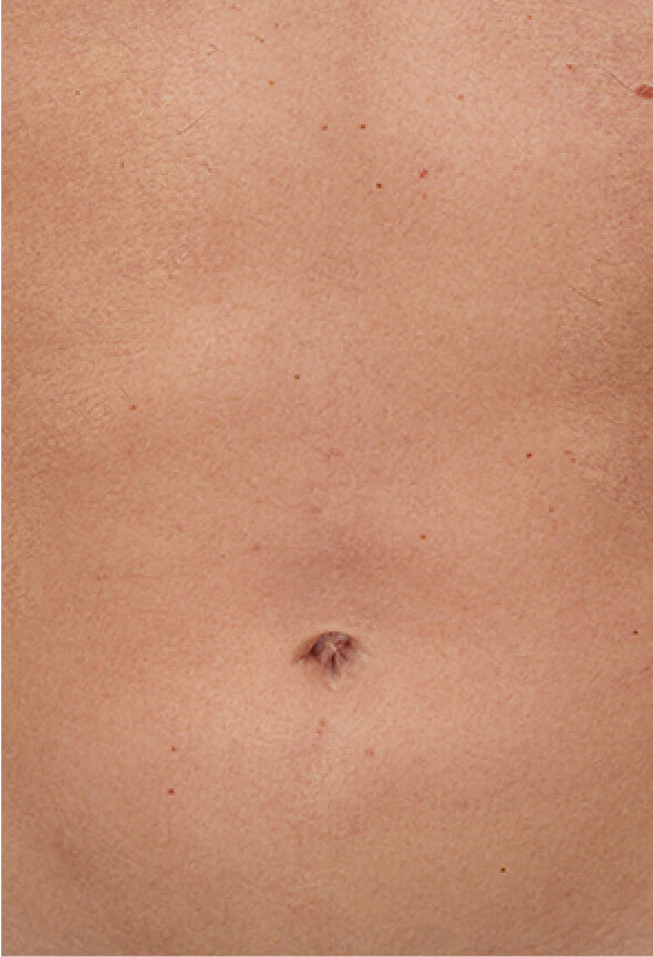 After effective IPL Hair Removal for Chest area with Ulike Air