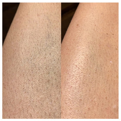 ボディ・フェイスケア UlikeAir2IPL Ulike Air 2 IPL Hair Removal for Underarm, Bikini & Legs Hair