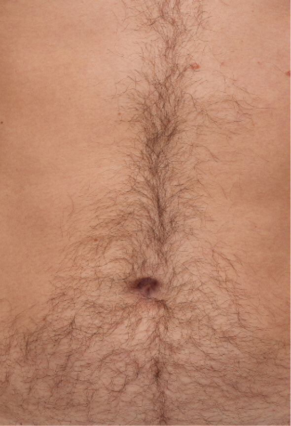 Before effective IPL Hair Removal for Chest area with Ulike Air