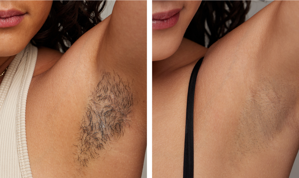 Before and after underarm hair removal comparison on a woman, showing a significant reduction in hair for smoother skin.