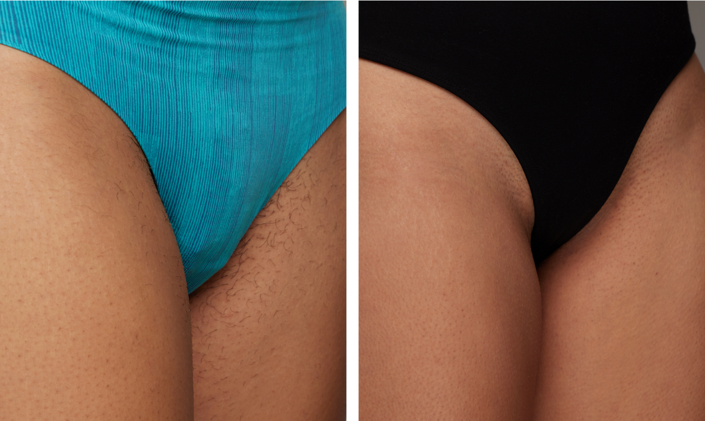 Before and after bikini line hair removal comparison on a woman, showing smoother skin and reduced hair.