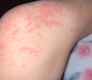 Can Hair Removal Creams Cause Chemical Burns