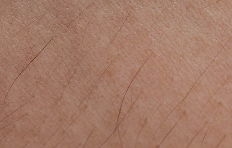 Comparing PCOS and Endometriosis in Terms of Hair Growth