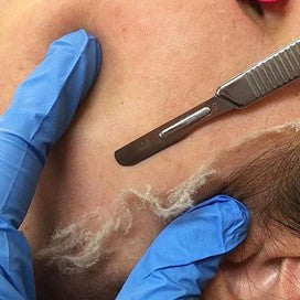 Dermaplaning Patillas