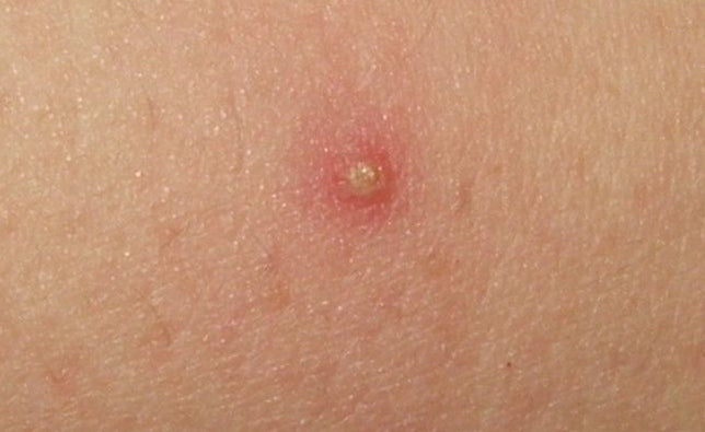 Folliculitis