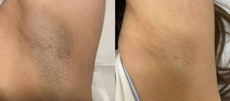 ¿Cómo puedo conseguir la longitud ideal del pelo para la depilación láser de forma natural?