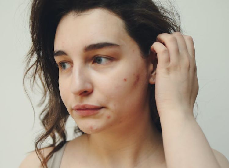 How to Prevent Pimples After Shaving