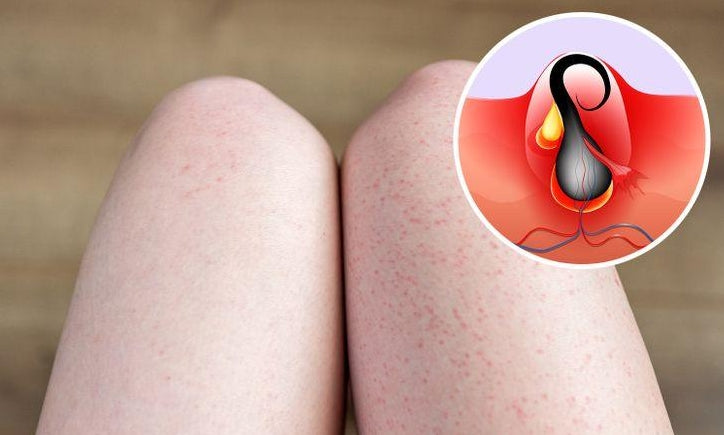 How to Remove Strawberry Legs