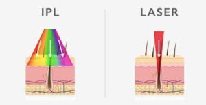 IPL Hair Removal Vs Laser Hair Removal