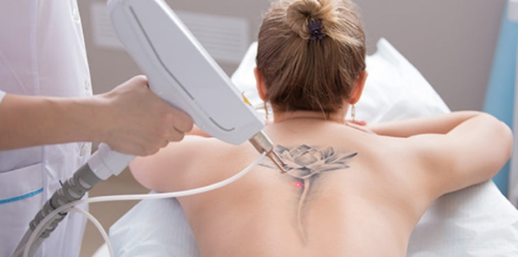 ¿Existe algún dispositivo de depilación IPL que funcione para tatuajes o piel oscura?