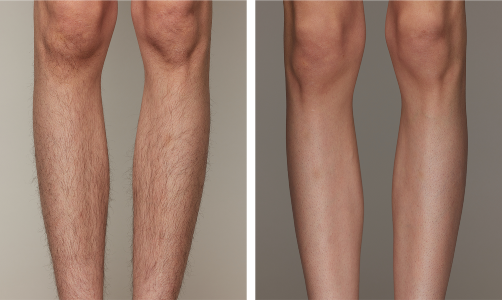 Before and after leg hair removal comparison on a person, showing smoother skin and reduced hair.