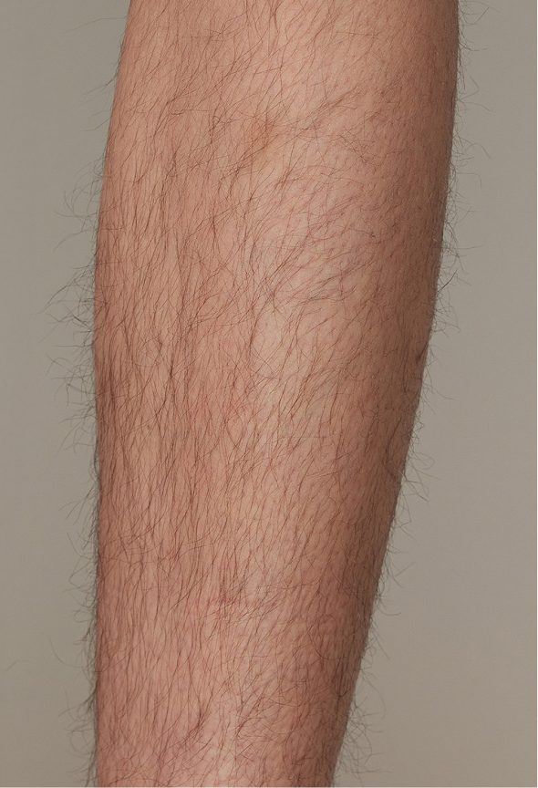 Effective IPL Hair Removal for Arm area with Ulike Air