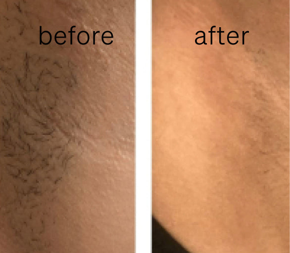 How to Get Rid of Mole Hair Long-lastingly?