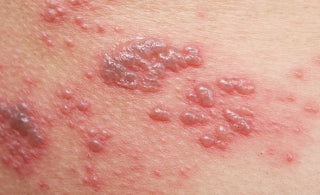 Redness and Blisters