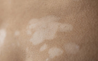 Skin Discoloration