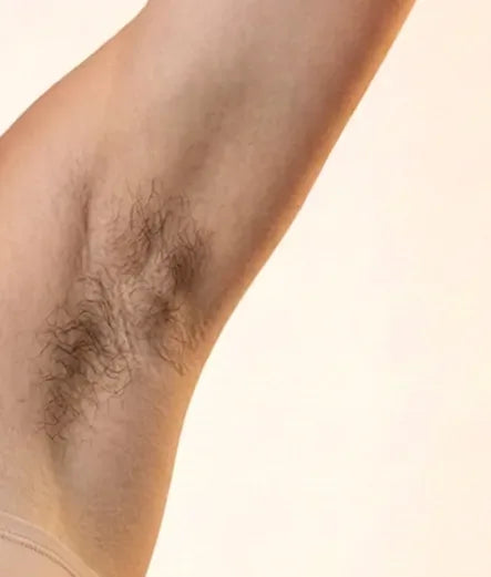 Armpits: underarm with visible hair, before