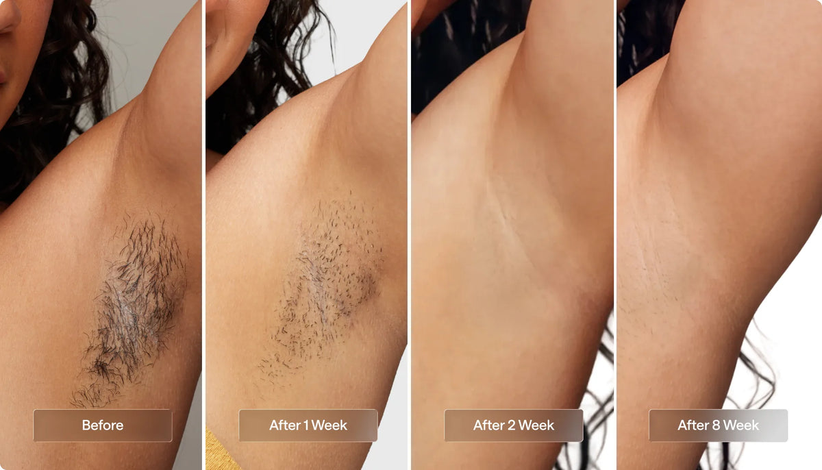 Underarm results at 1, 2 and 8 weeks