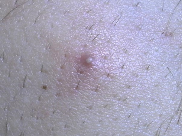 Ingrown Hair
