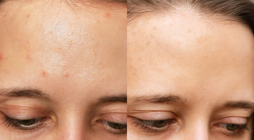 Before and After